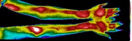 Thermogramme de deux bras